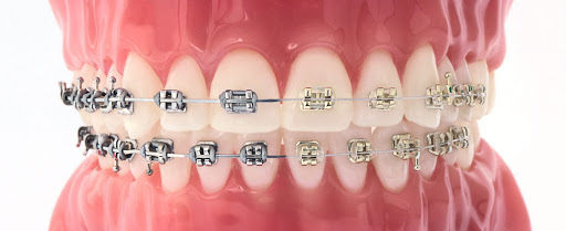 Mouth mold with braces